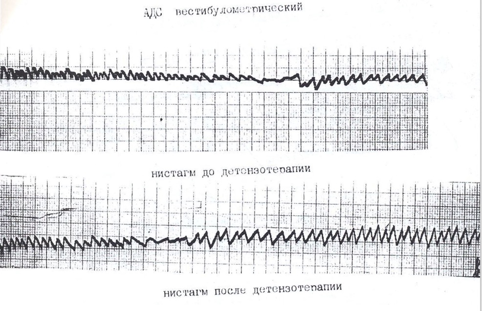 Новые технологии в вестибулометрии